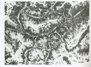 بيماريهاي تخمدان و لوله هاي رحمي چیست؟(1)